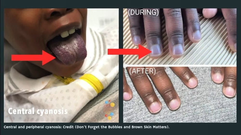 Edema (Swelling in the Feet and Legs)