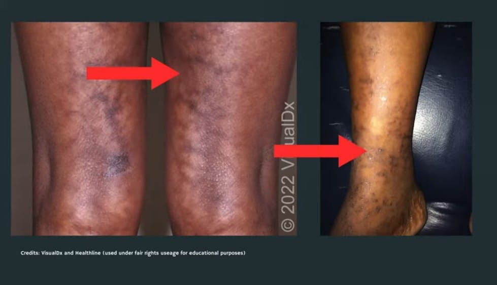 Cyanosis (Blue or Purple Skin)