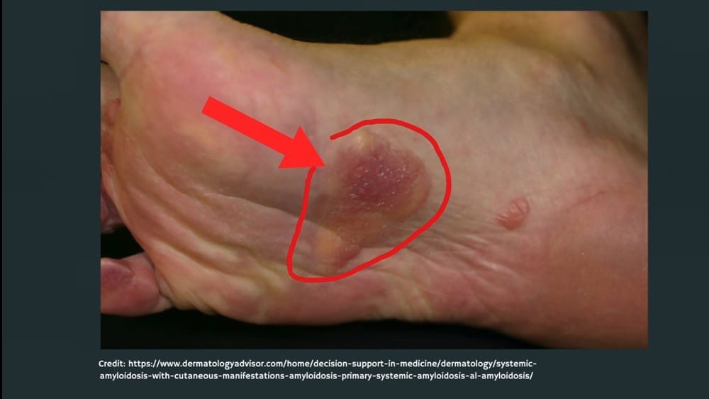 Eruptive Xanthomas (Sudden Waxy Bumps)