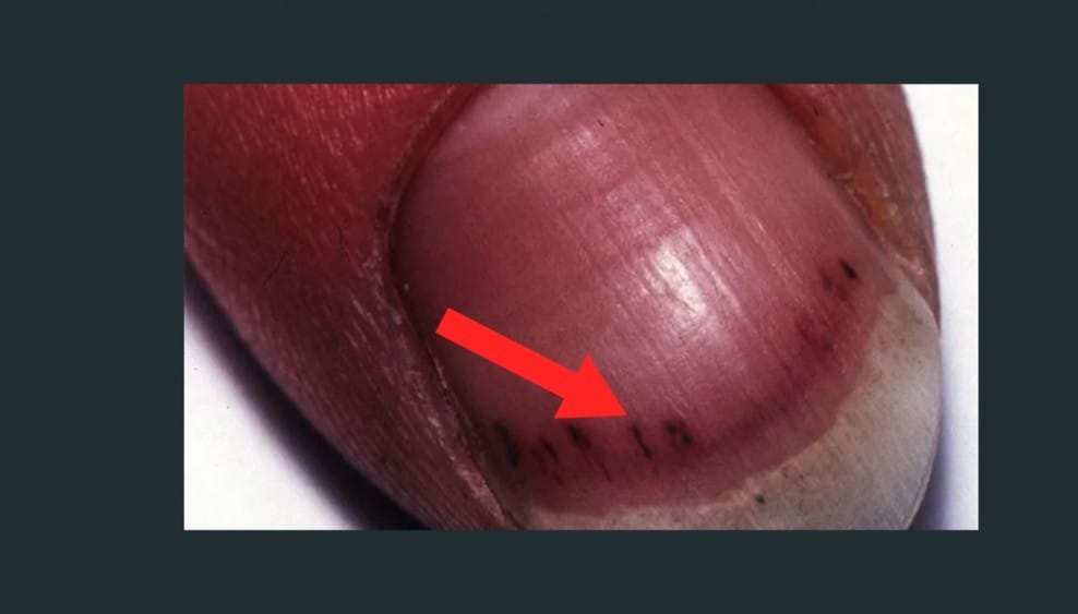Splinter Hemorrhages (Red or Purple Lines Under the Nails)