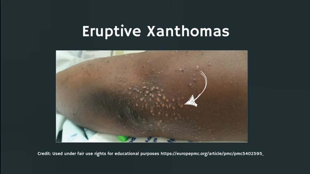 Xanthelasma and Xanthomas (Cholesterol Deposits)